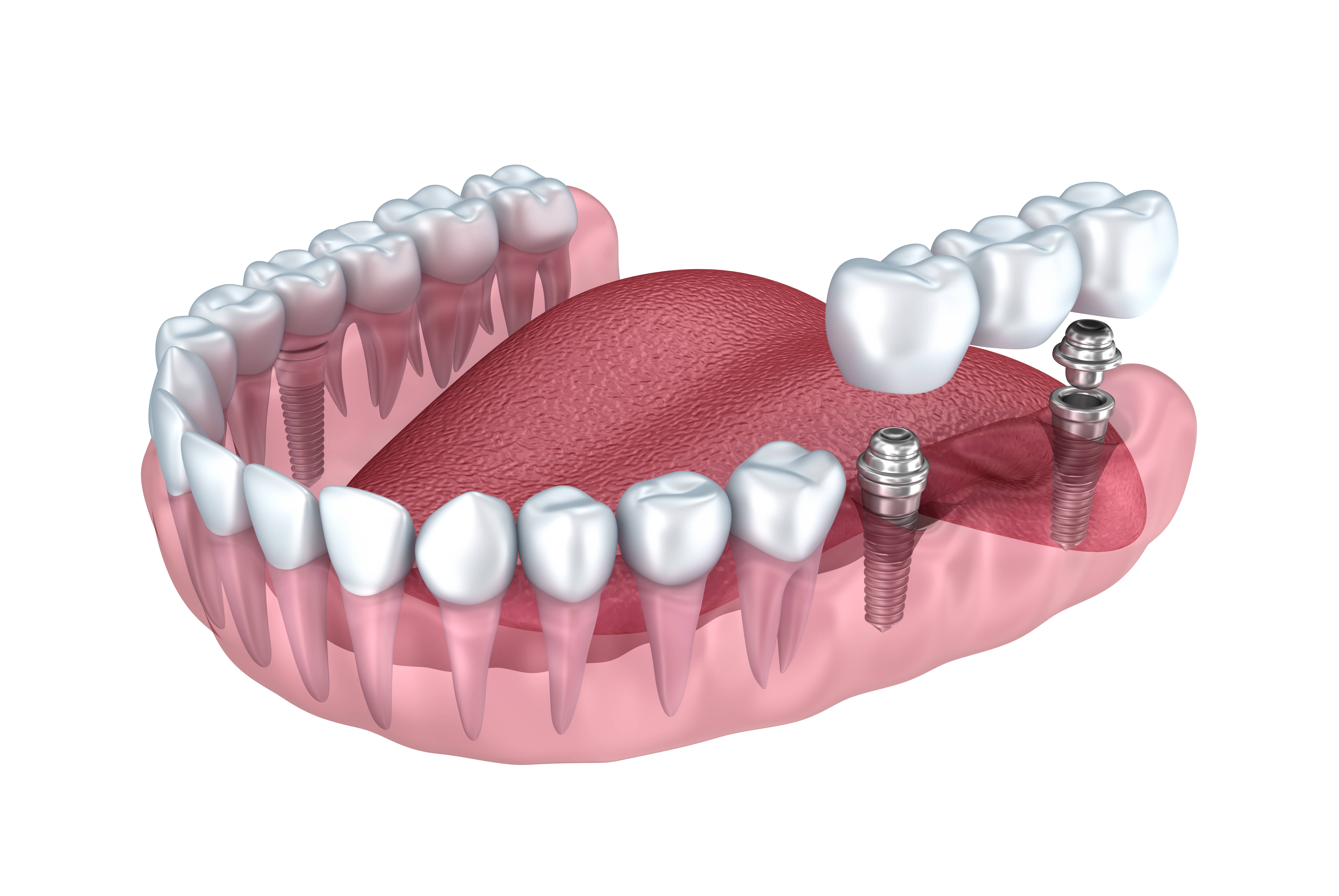 dental-implant-1.jpeg