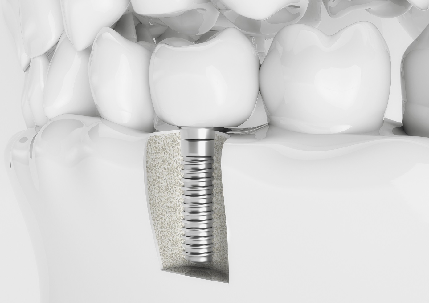 implant-5.jpg