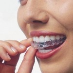 invisalign brace