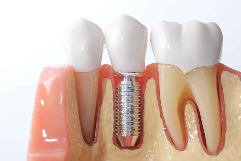 Dental Implants Manchester
