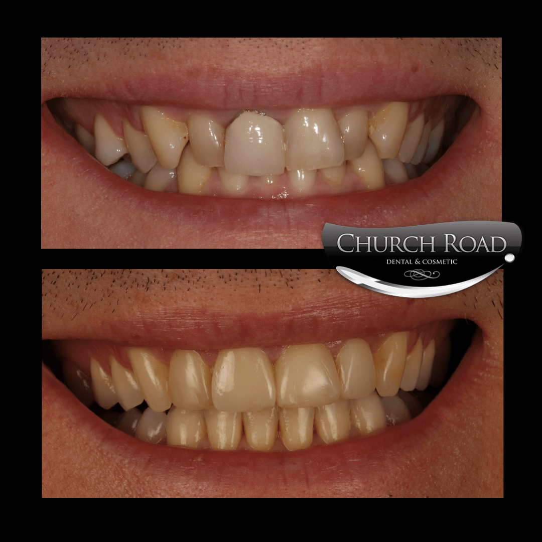 composite veneers at Church Road Dental and Cosmetics, Cheshire