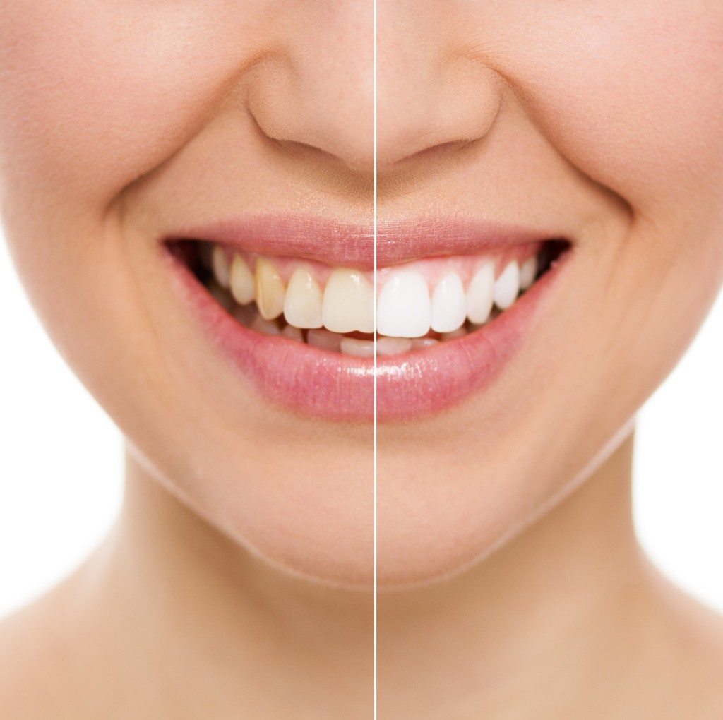 Chipped Tooth Repair - How A Cosmetic Dentist Can Help
