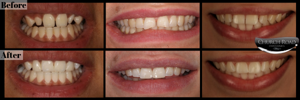Composite Bonding at Church Road Dental and Cosmetics, Cheshire