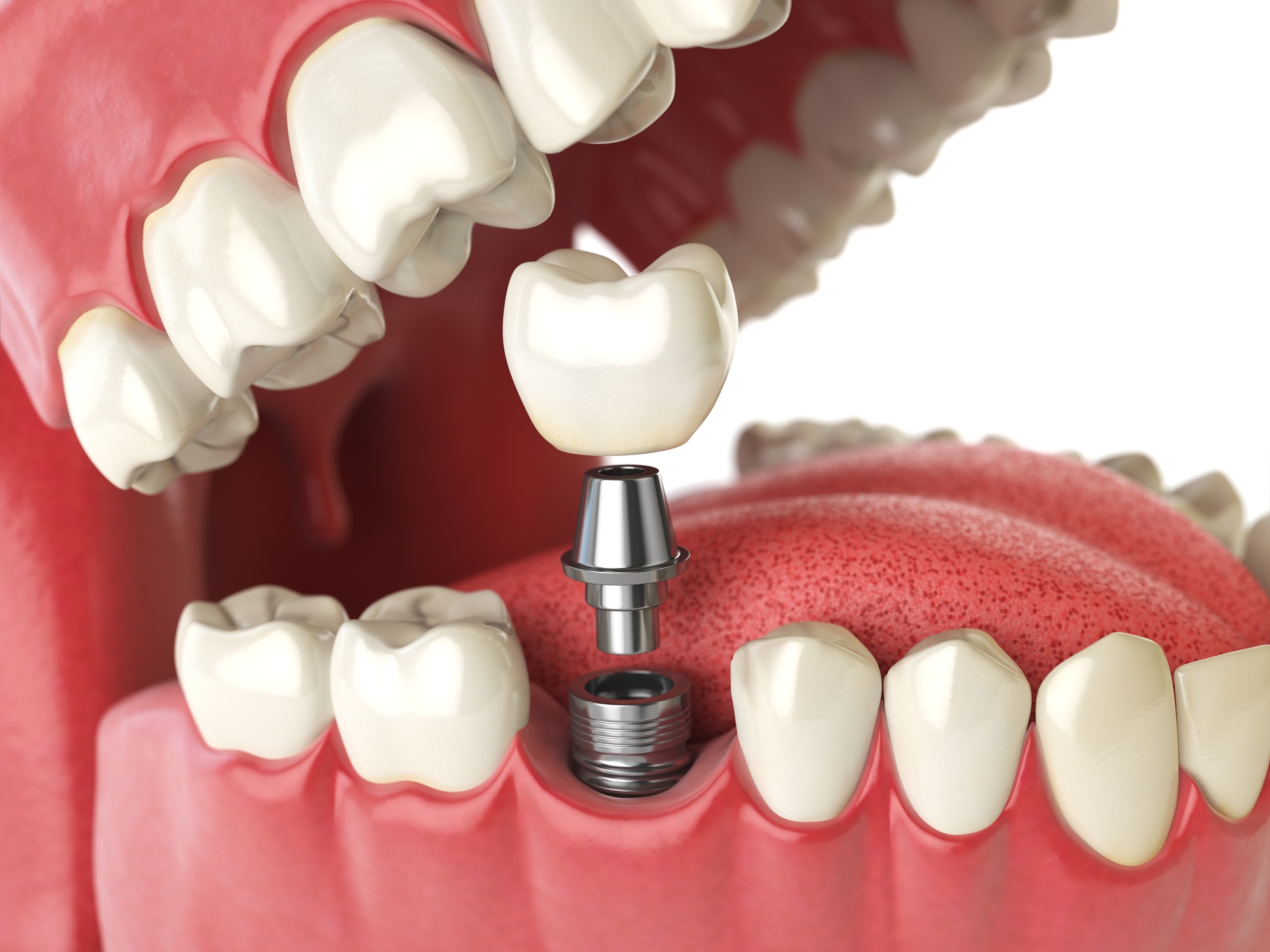 Dental Implants Manchester – Does The Procedure Hurt