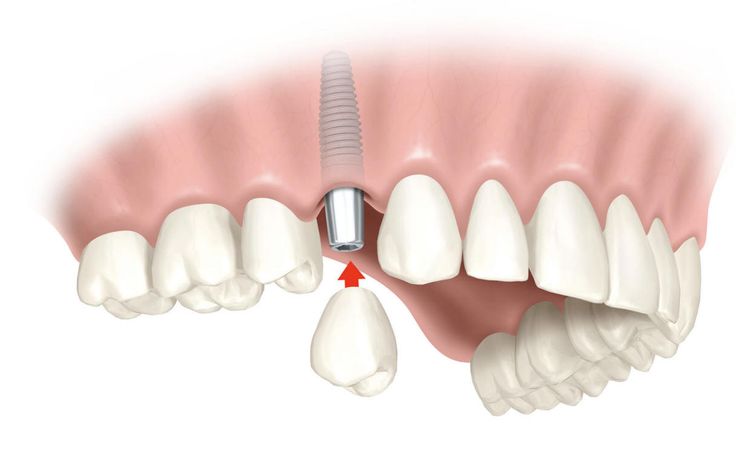 Manchester Crown Clinic- 4 Reasons to Choose Dental Implants