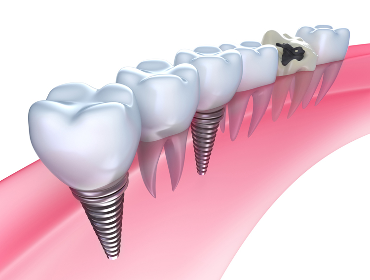 Dental Implants Manchester - Versatility Explained