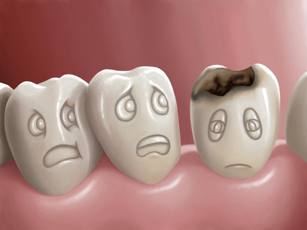 Tooth Decay – Treatment Types And How To Prevent It