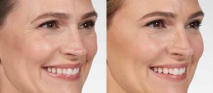 showing effects of wrinkle softening treatments