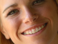 adult braces fixed ceramic