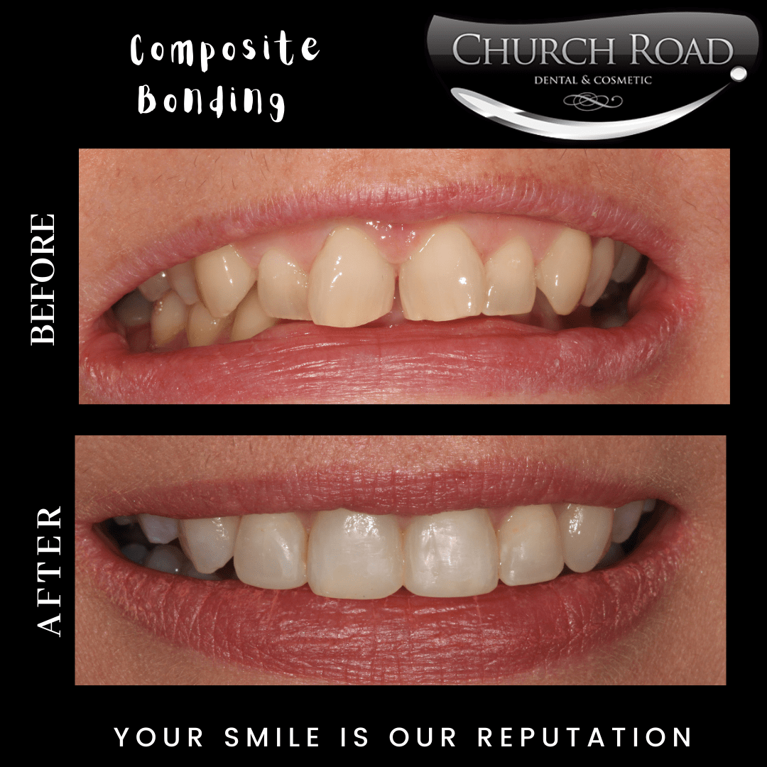 composite bonding before and after