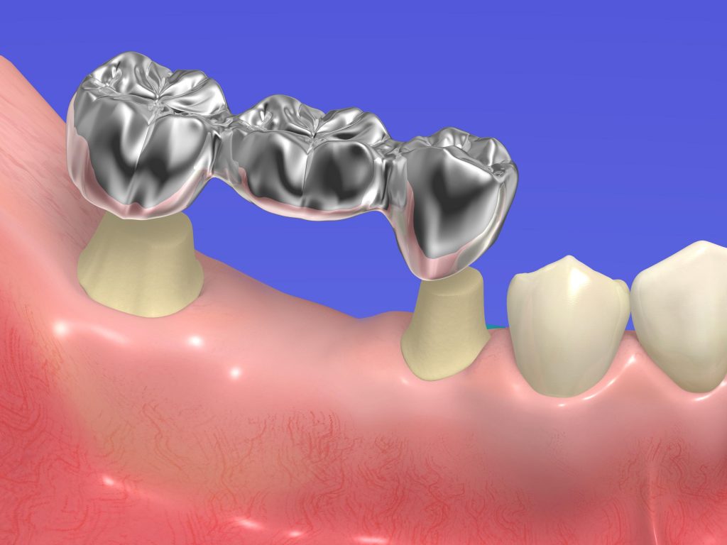 Exploring The Differences Between Dental Implants And Dental Bridges