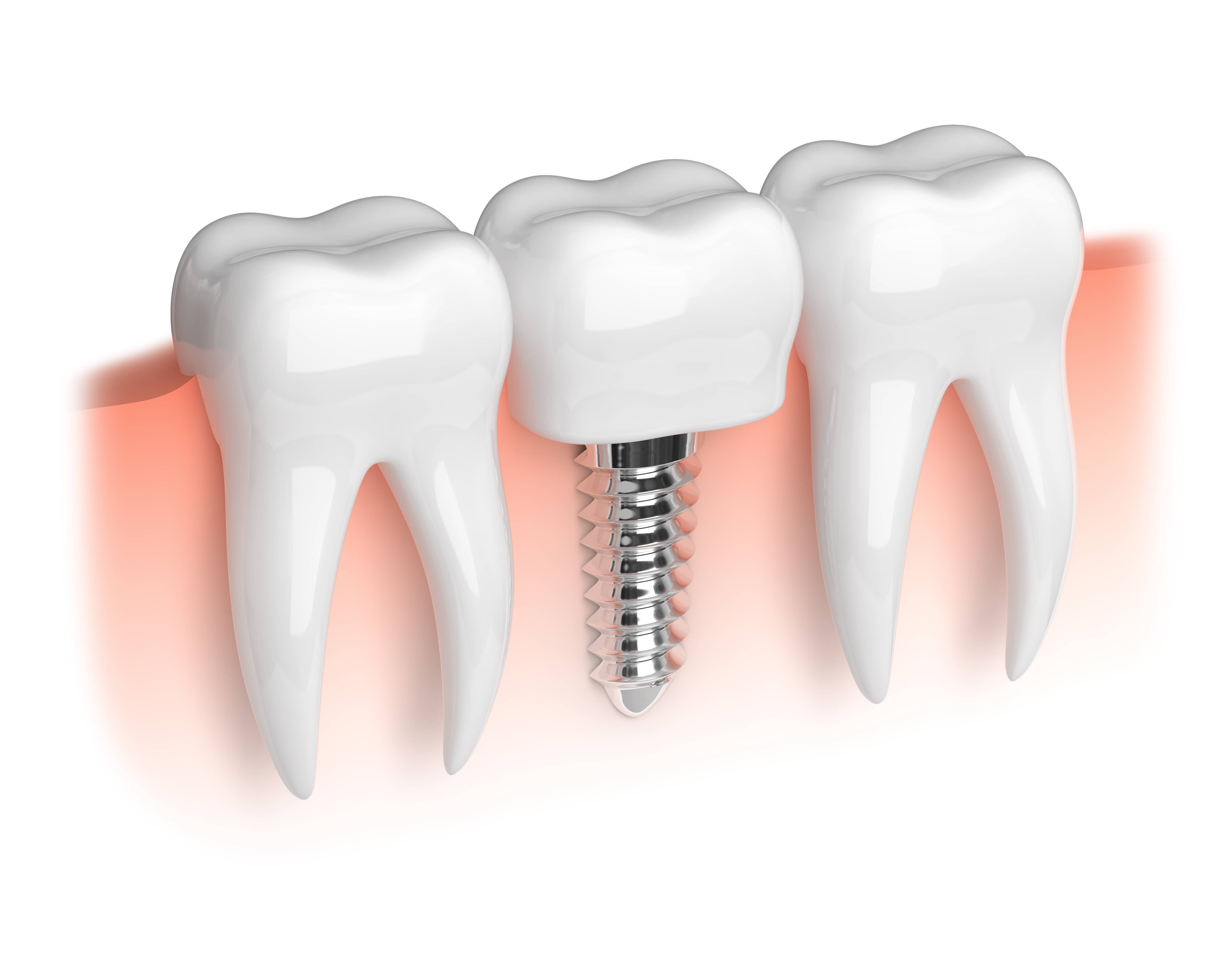 Finding dentists for Dental Implants Uk