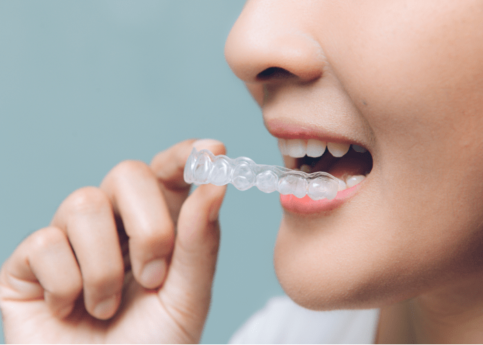What an Invisalign aligner looks like