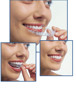 Adult braces clear aligners