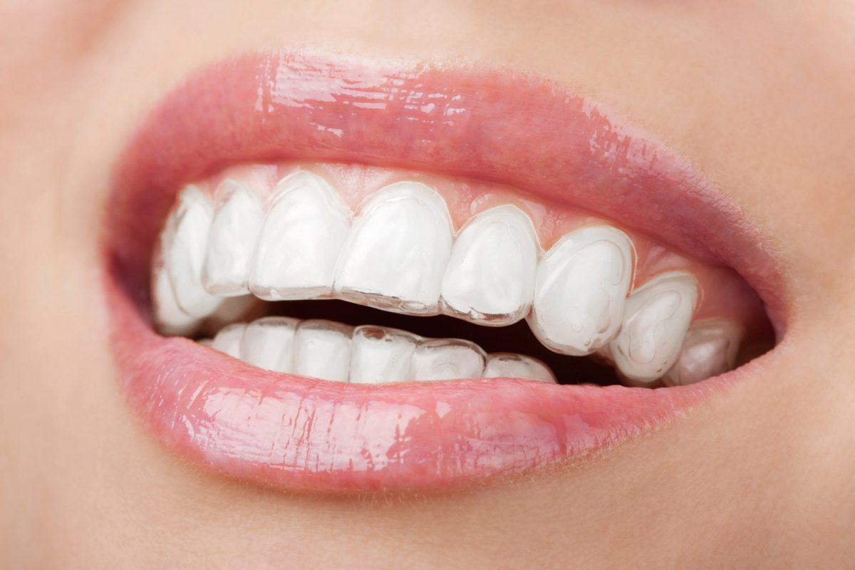 oralhealth, dentalhealth, dentist, teeth,oralhealth, dentalhealth, dentist, teeth,