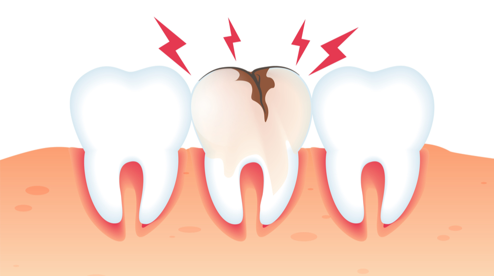 Broken Tooth Repair