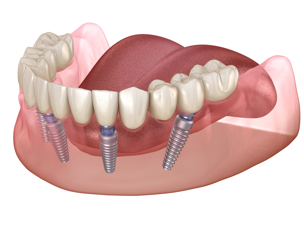All-On-4 Dental Implants In Manchester - How's & Why's ... All-On-4 Dental Implants In Manchester - How's & Why's ...