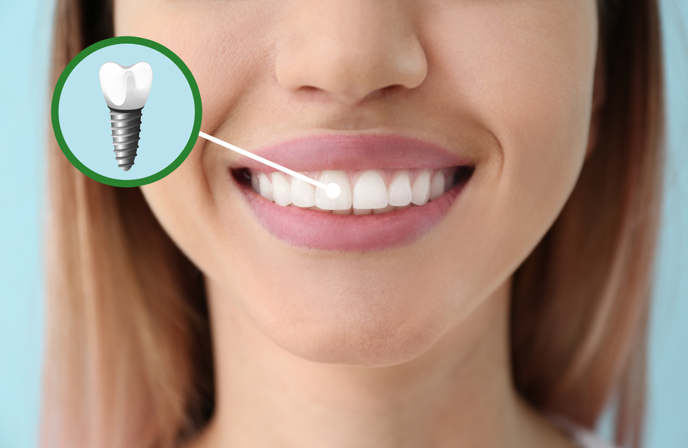 What are the Three Main Types of Dental Implants?