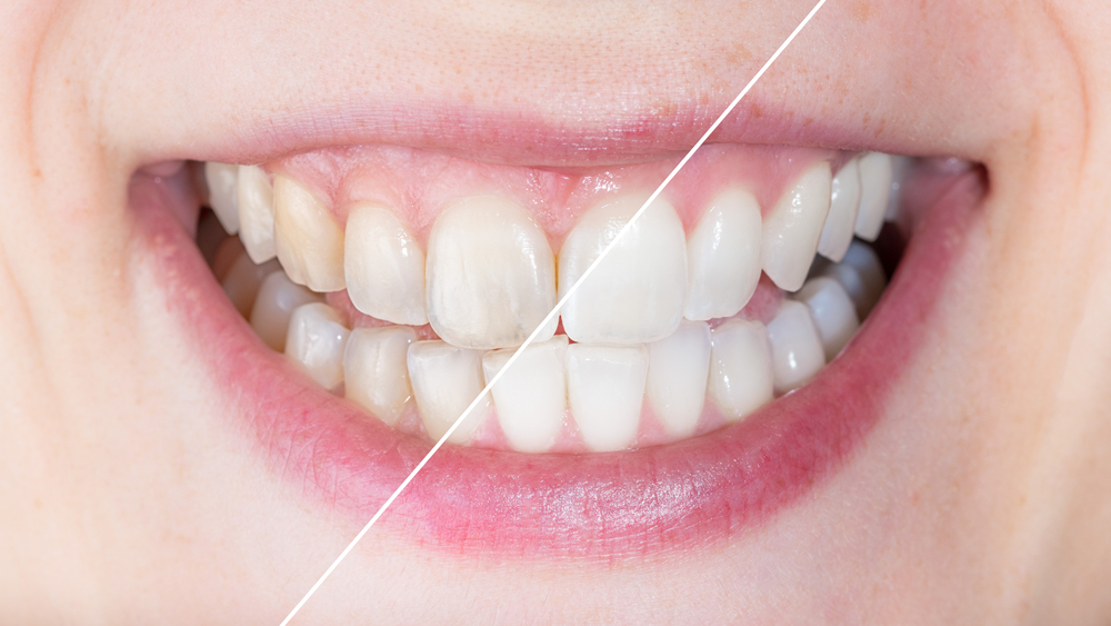 Does Teeth Whitening Damage Your Teeth? Cheadle Hulme Dental » Cheadle Dental Blog