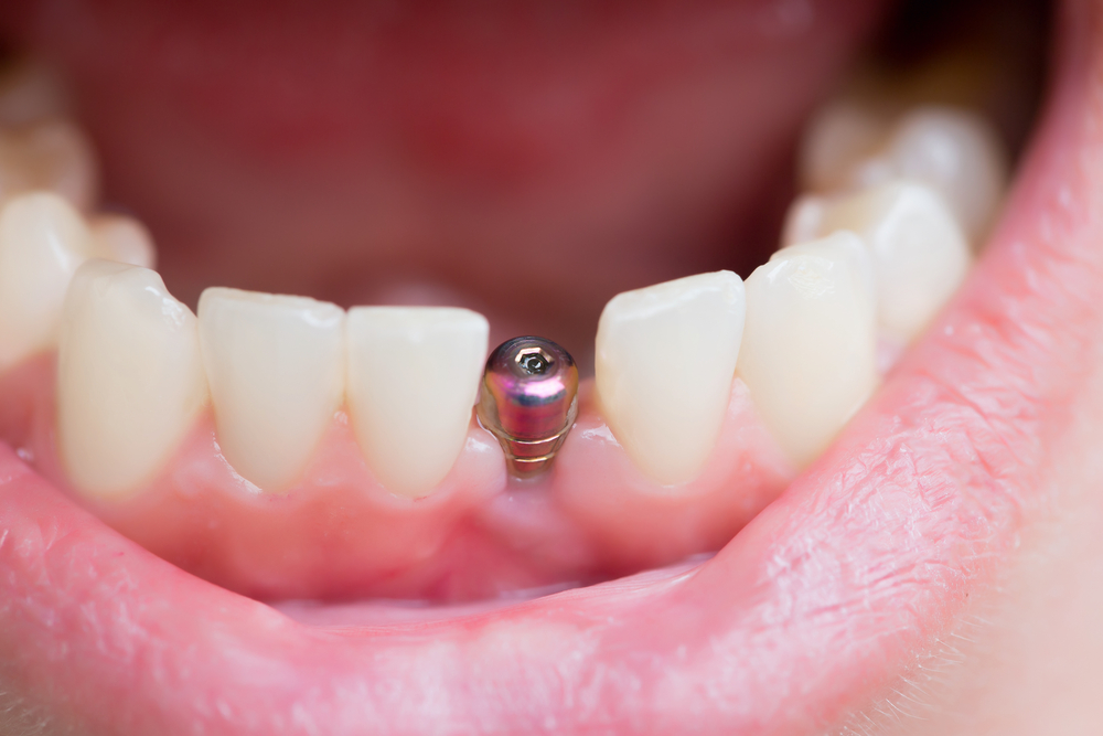 Teeth Dentures Manchester  - Get Brand New Teeth In A Day!