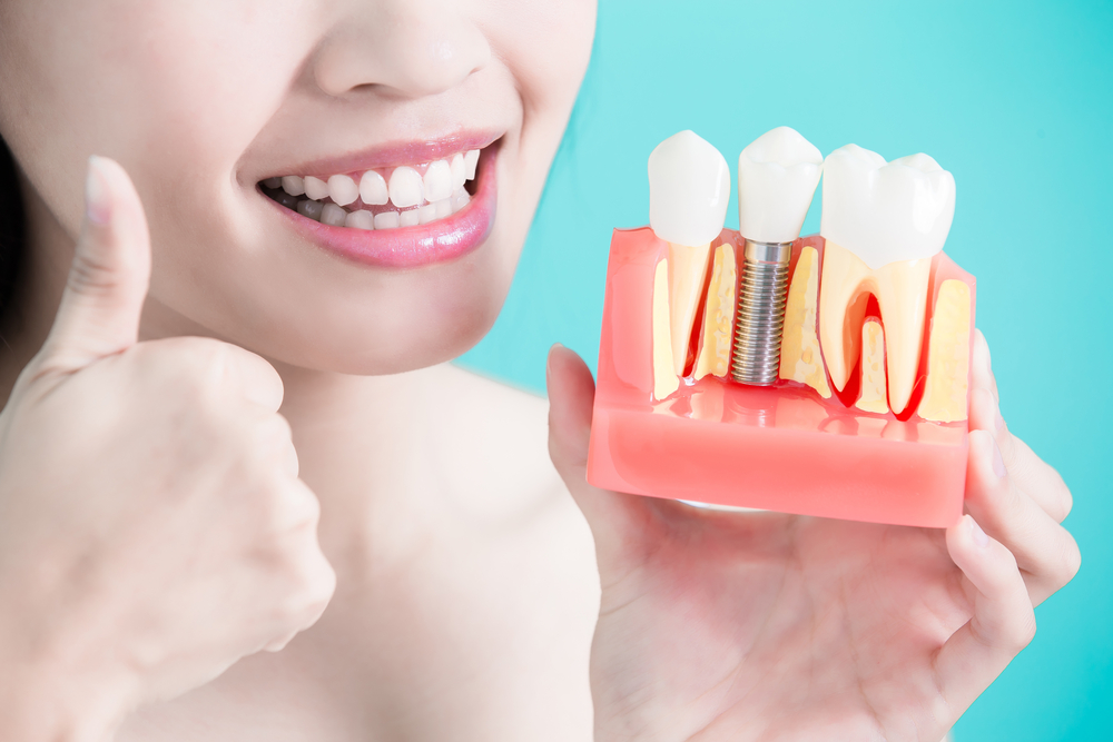 Dental Implants Manchester