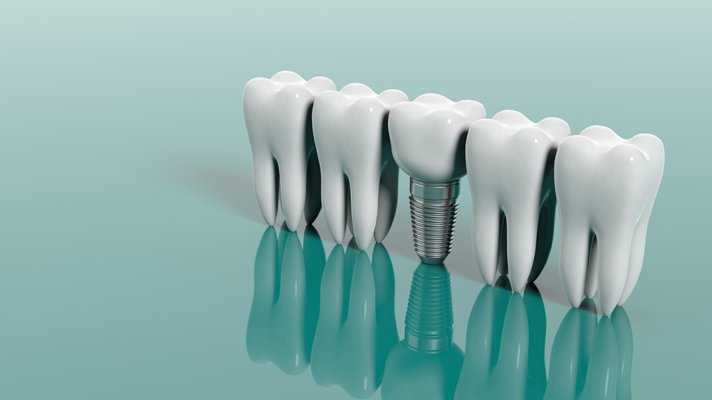Dental Implants Manchester