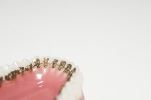 Adult braces- lingual braces