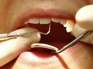 looking after veneers