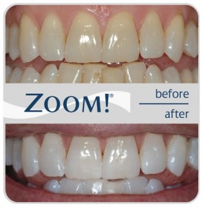 zoom whitening treatment results