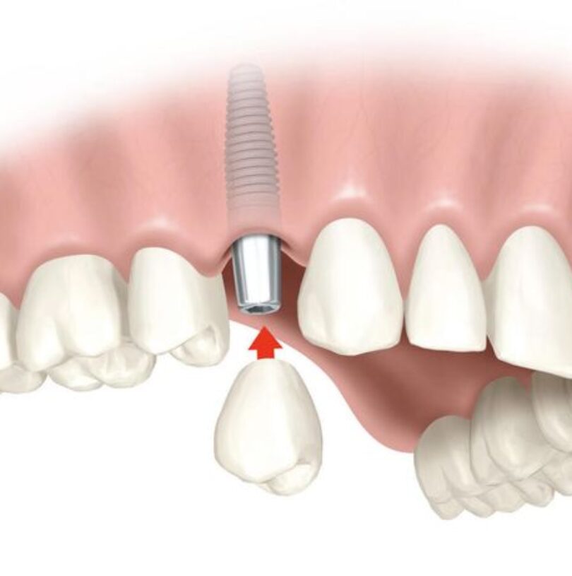 blog - Cheadle Hulme Dental