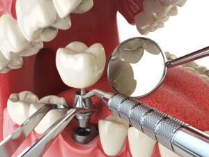 Dental Implants Manchster