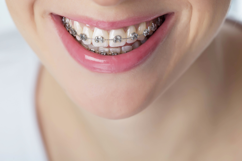 Braces For Adults: What to Know About Clear Aligners - Inner Banks Dental
