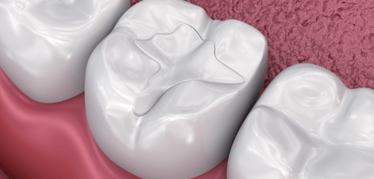 Composite Fillings