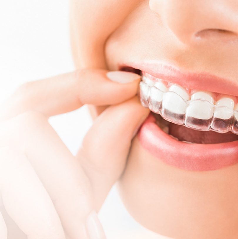 VAT on clear aligners in Manchester