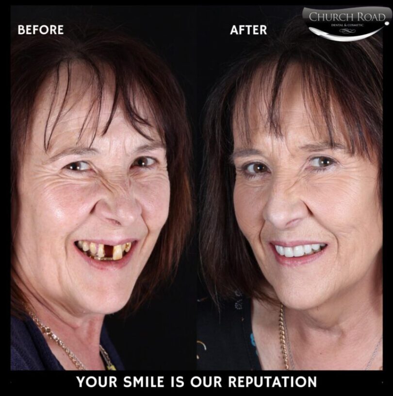 All on four/same day smile procedure we completed recently.