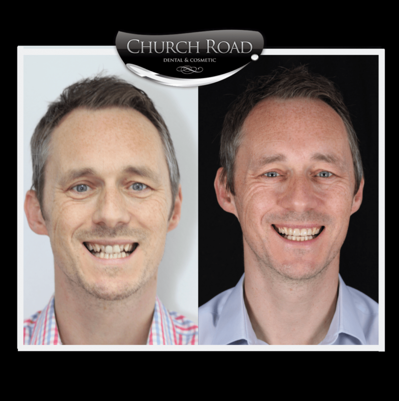 Composite veneers at Church Road Dental and Cosmetics, Cheshire