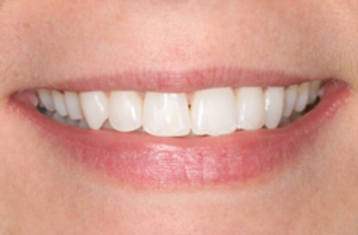 After - Cheadle Hulme Dental
