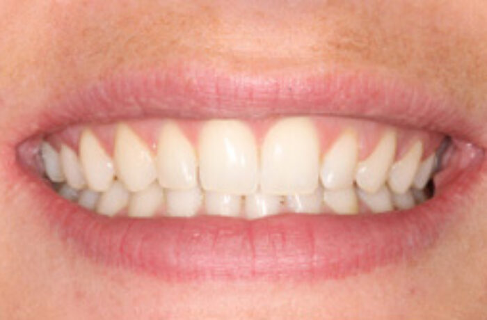 After - Cheadle Hulme Dental