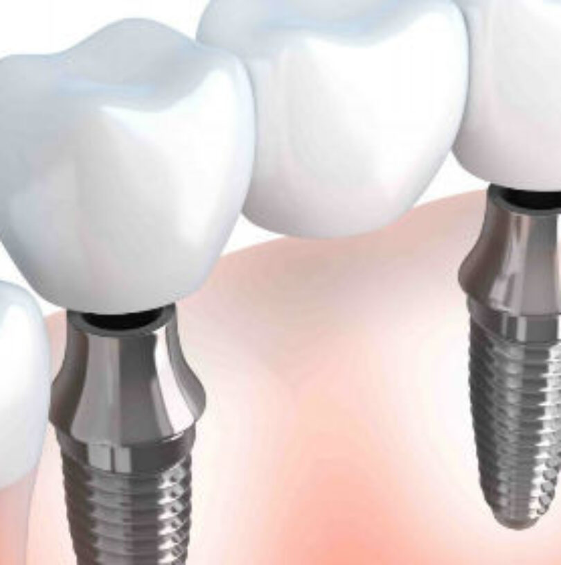 blog - Cheadle Hulme Dental