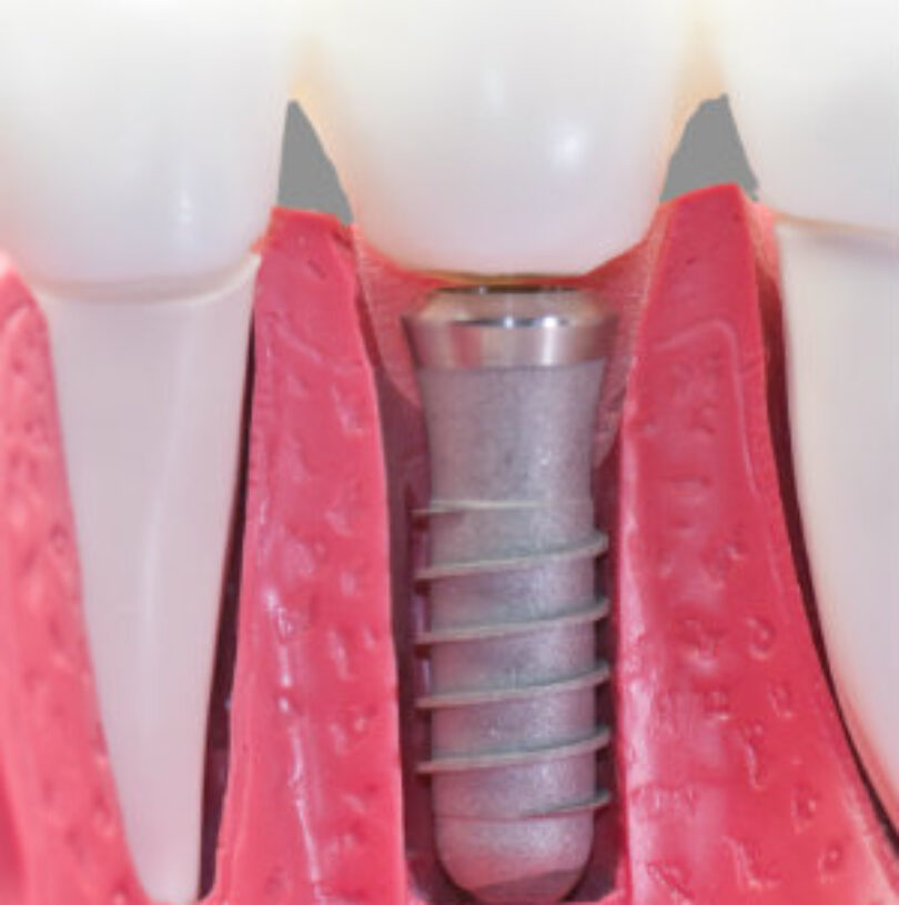 blog - Cheadle Hulme Dental
