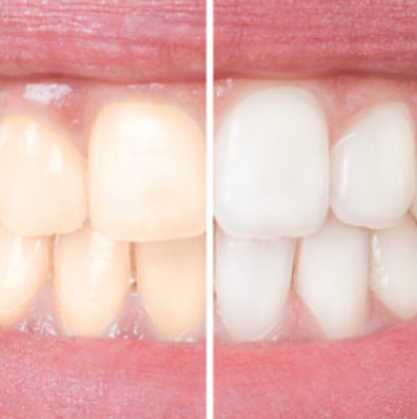 blog - Cheadle Hulme Dental