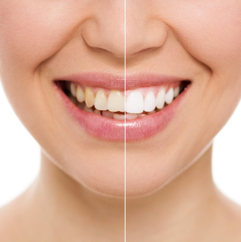 blog - Cheadle Hulme Dental