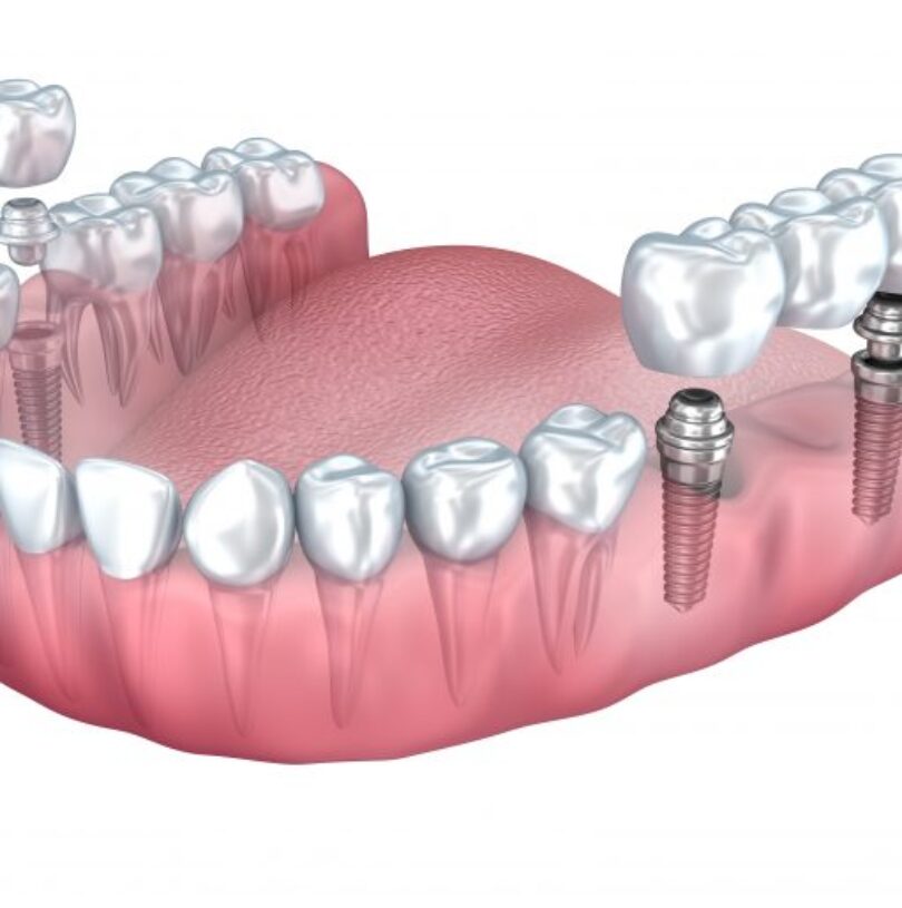 blog - Cheadle Hulme Dental