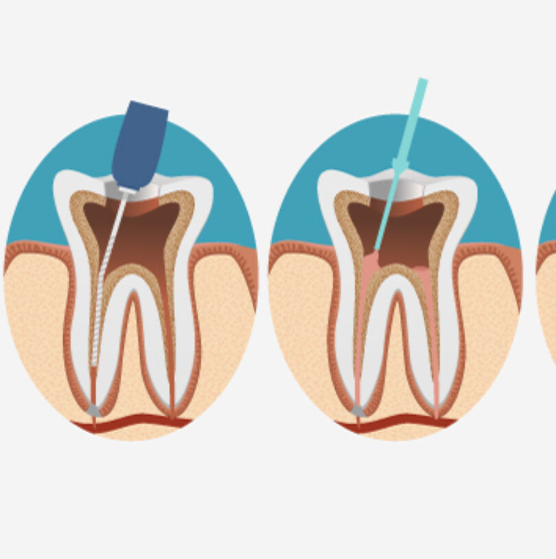 Dental Implants Manchester Or A Root Canal Which Is It To Be