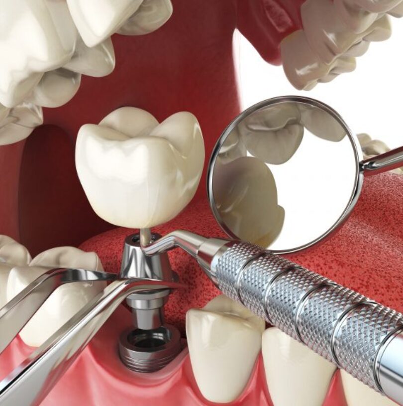 blog - Cheadle Hulme Dental