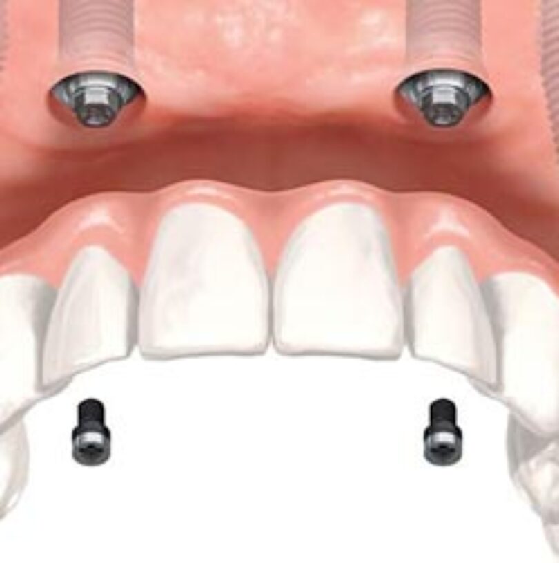 blog - Cheadle Hulme Dental