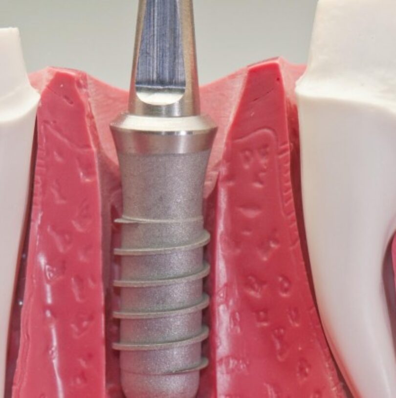 blog - Cheadle Hulme Dental