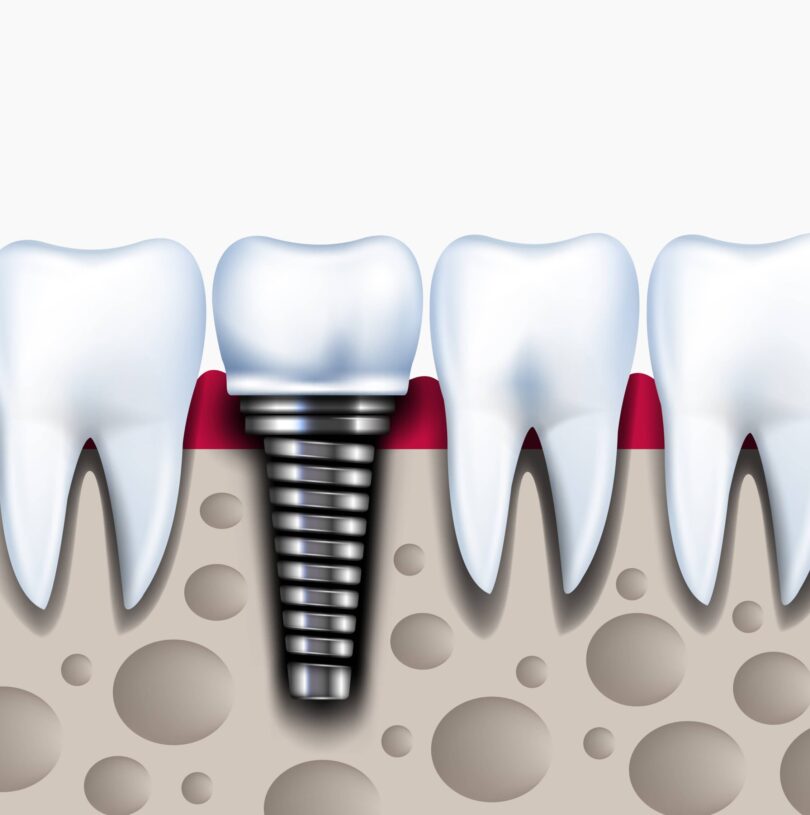 Dental Implants Manchester – Missing Teeth Replacement At Its Best