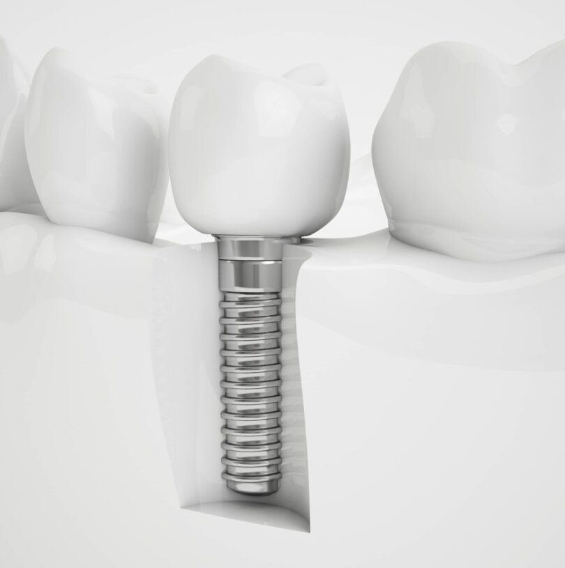 blog - Cheadle Hulme Dental