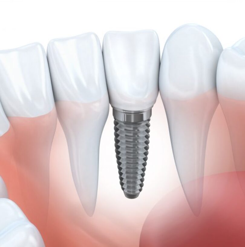 blog - Cheadle Hulme Dental
